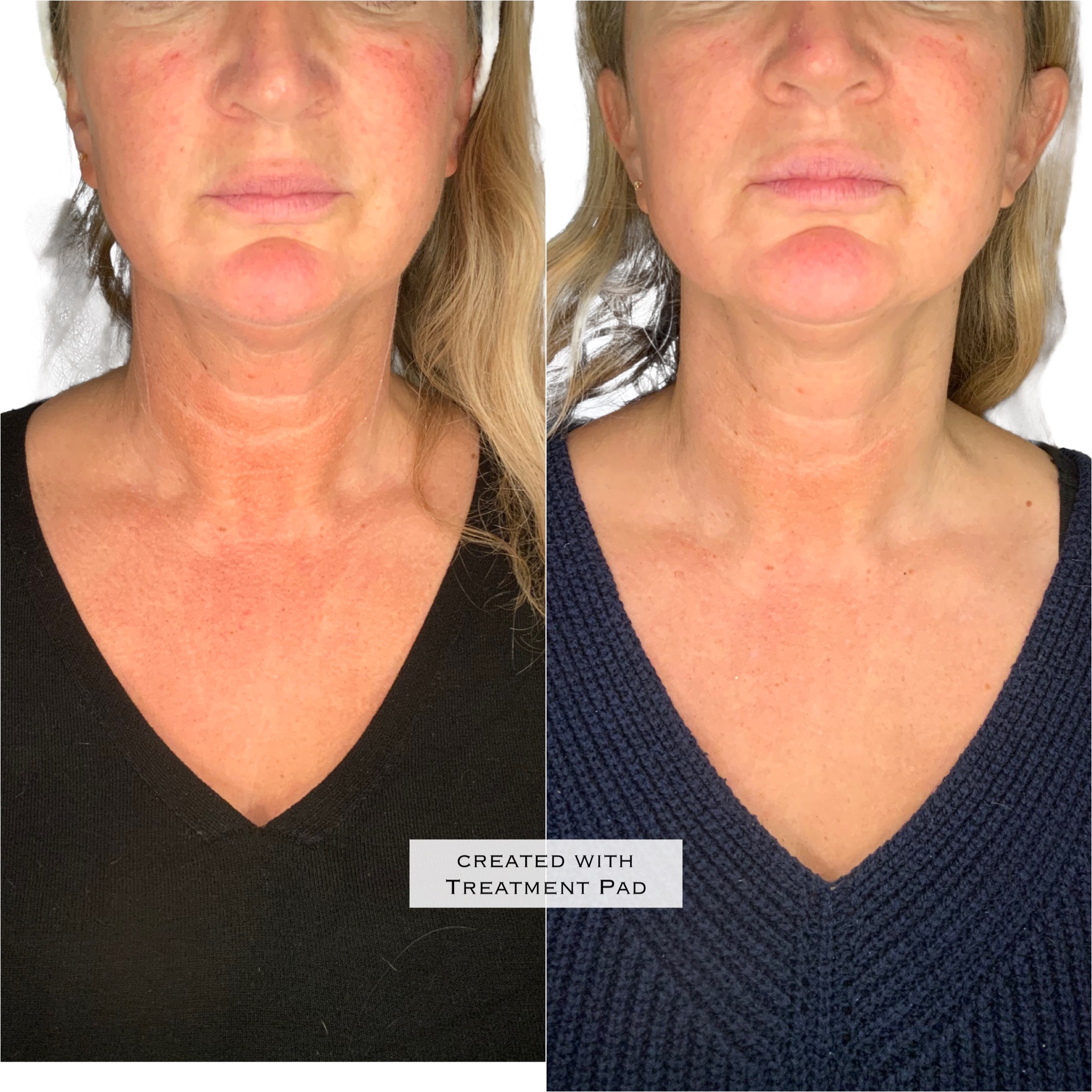 AGEJET advanced Plasma skin therapy coming very soon to the Cindy Knight Clinic – CHOOSE YOUR DOWNTIME!