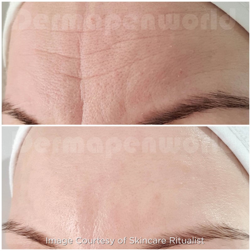 Dermapen Treatment